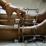 LIMB LENGTHENING SURGERIES IN INDIA TO BECOME TALLER