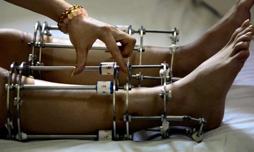 LIMB LENGTHENING SURGERIES IN INDIA TO BECOME TALLER