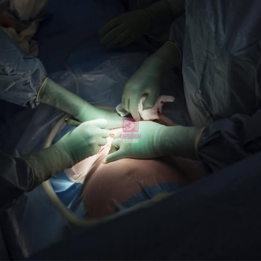 Kenya’s C-Section Rate Hits 20%, Surpassing WHO Recommendations