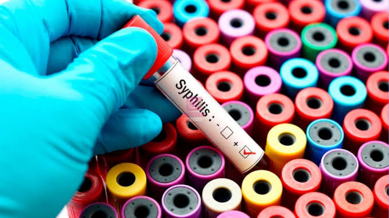 Nairobi Records Highest Syphilis Cases in Kenya as Health Officials Raise Alarm Over Rising Infections